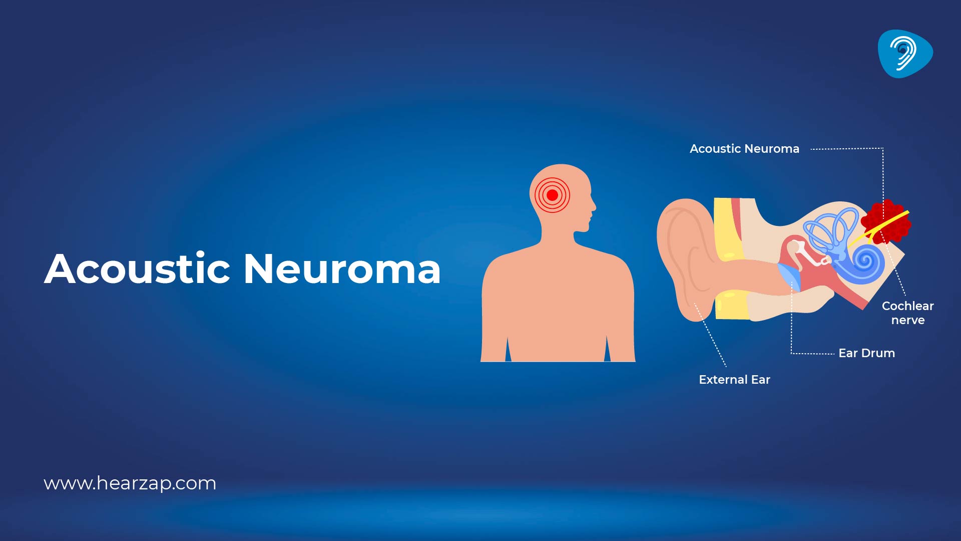 Acoustic Neuroma