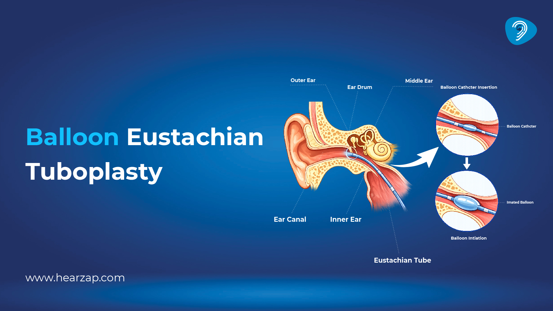 Balloon Eustachian tuboplasty 