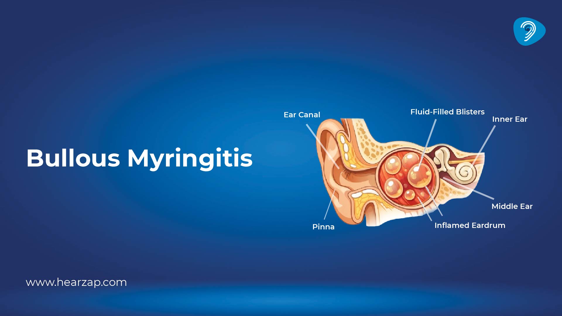 Bullous Myringitis