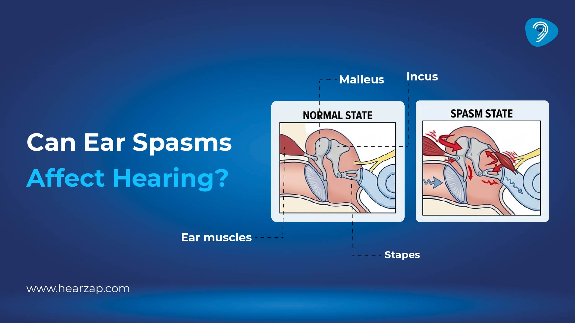 Can Ear Spasms Affect Hearing?