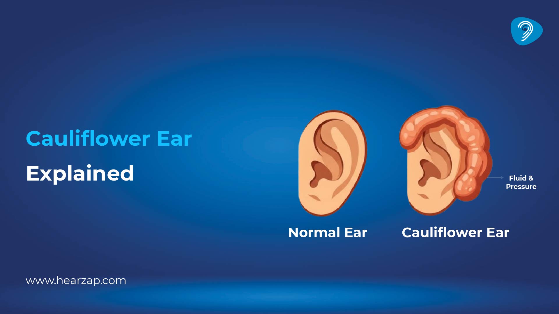 Cauliflower Ear Explained