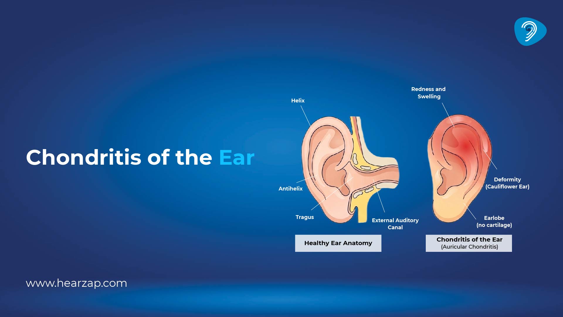 Chondritis of the Ear