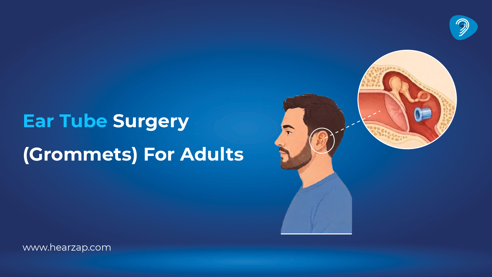 Ear Tube Surgery 