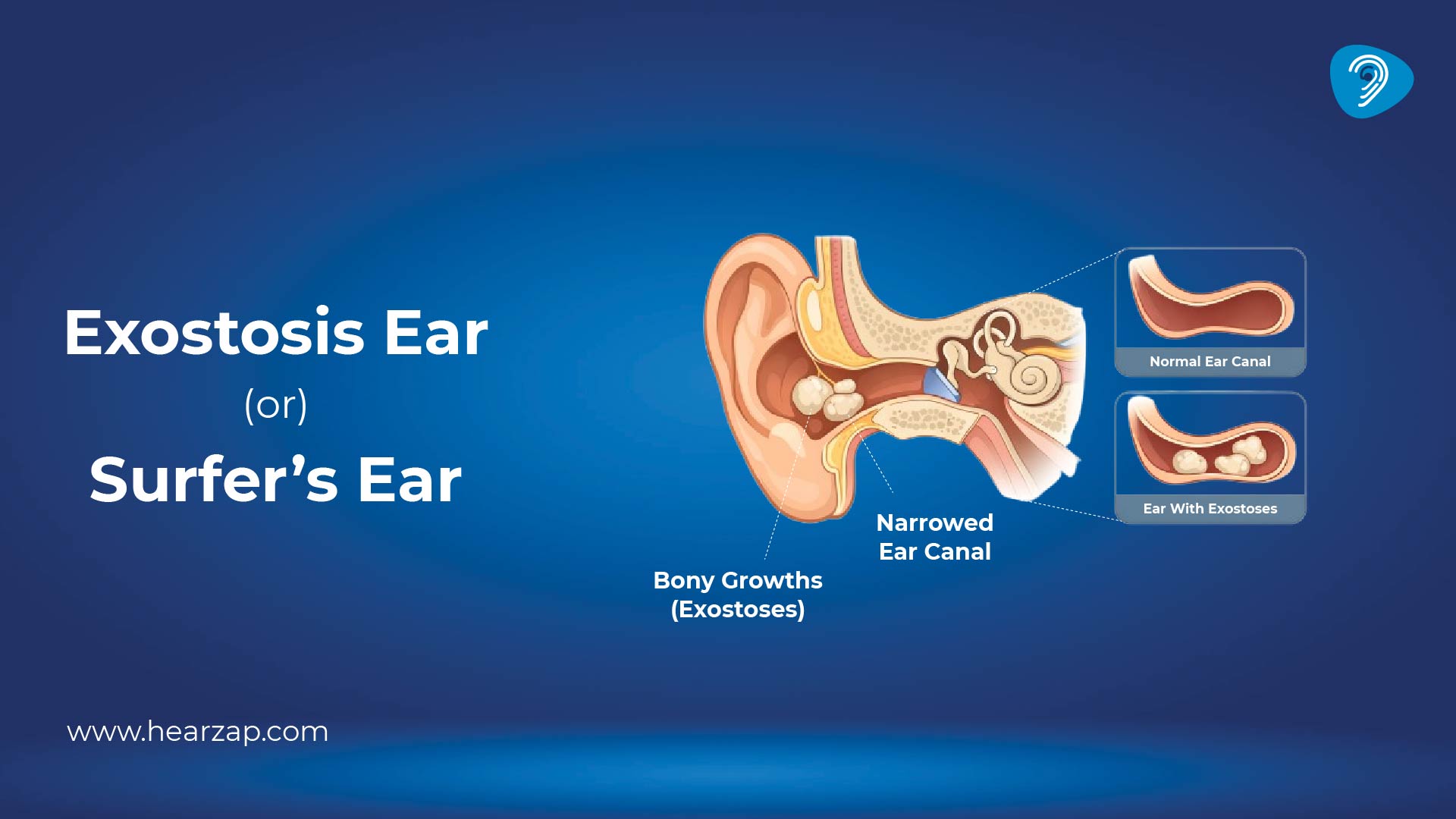 Exostosis Ear