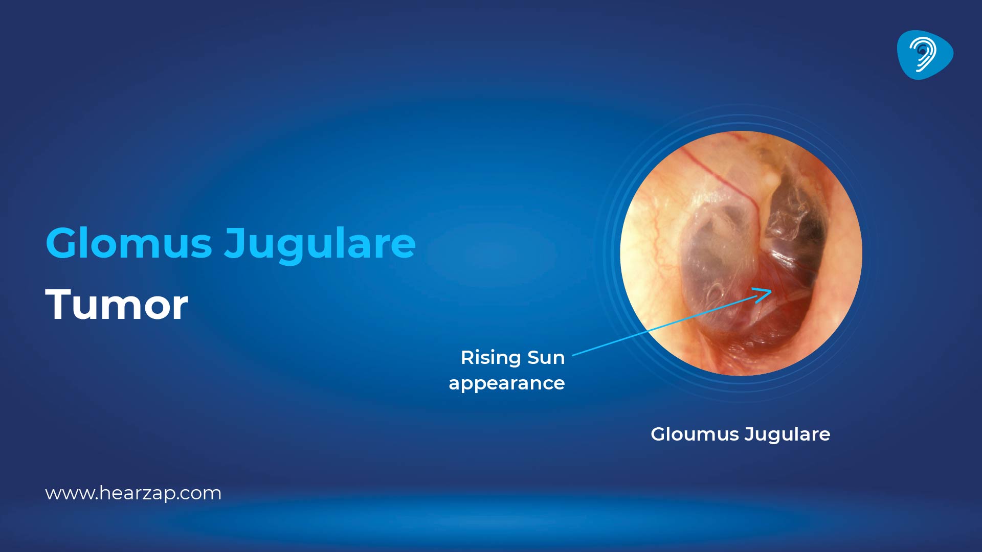 Glomus Jugulare Tumour
