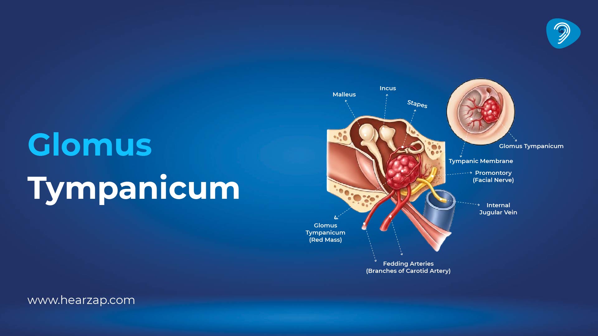 Glomus Tympanicum