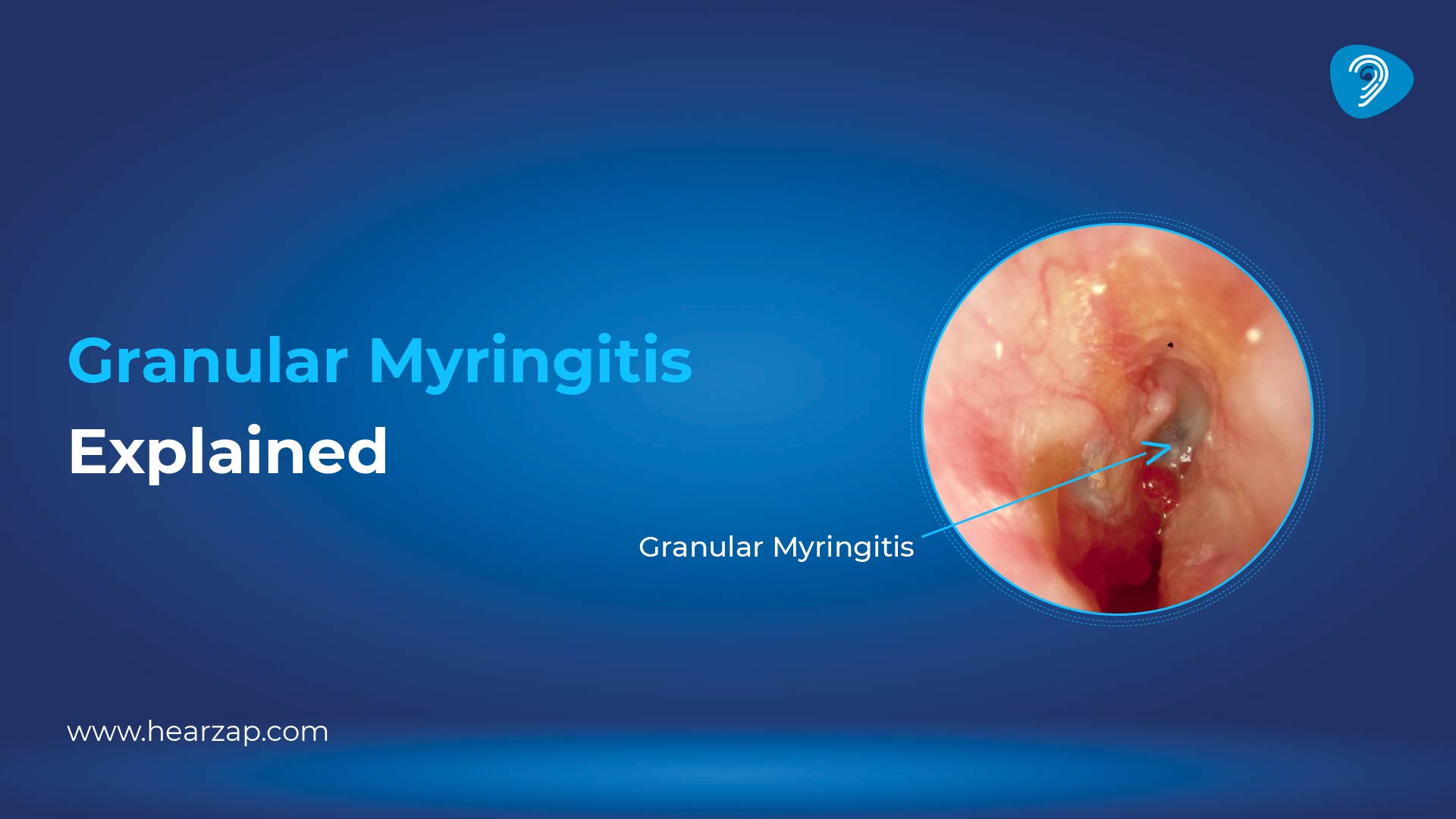 Granular Myringitis