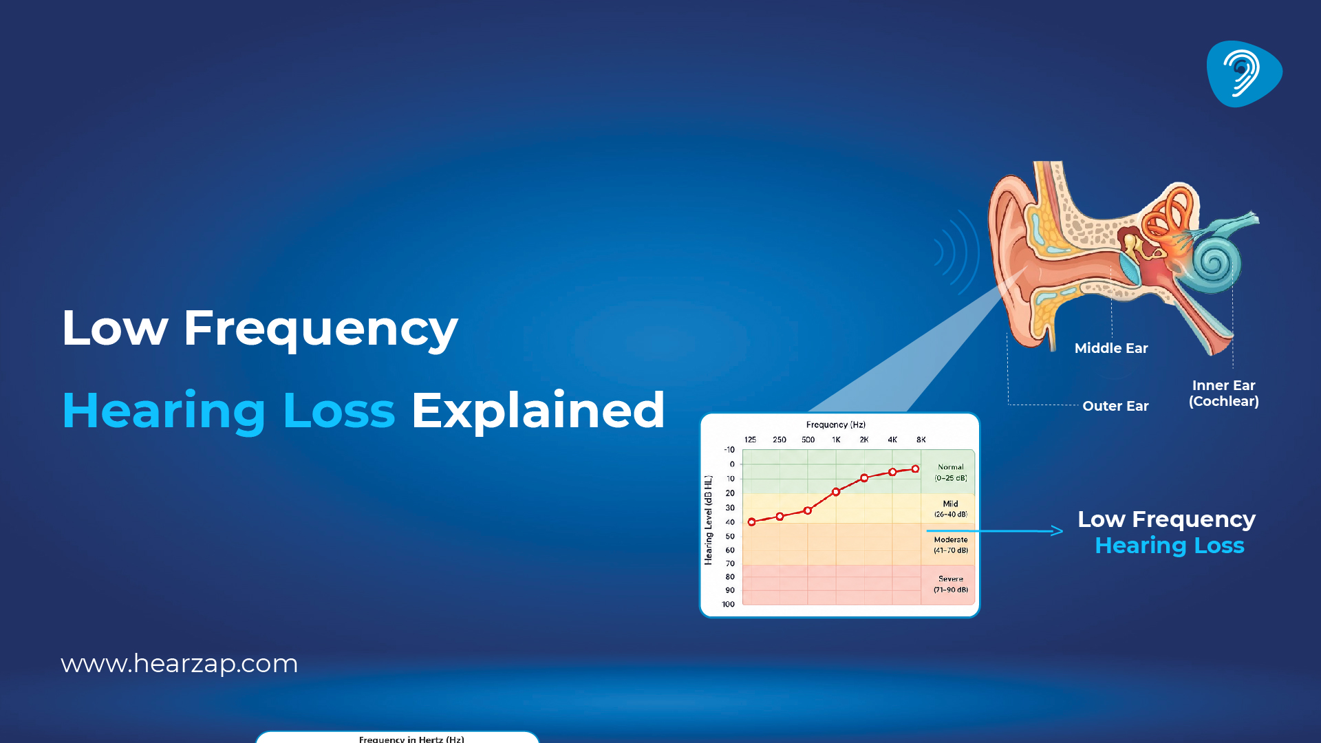  Low Frequency Hearing Loss