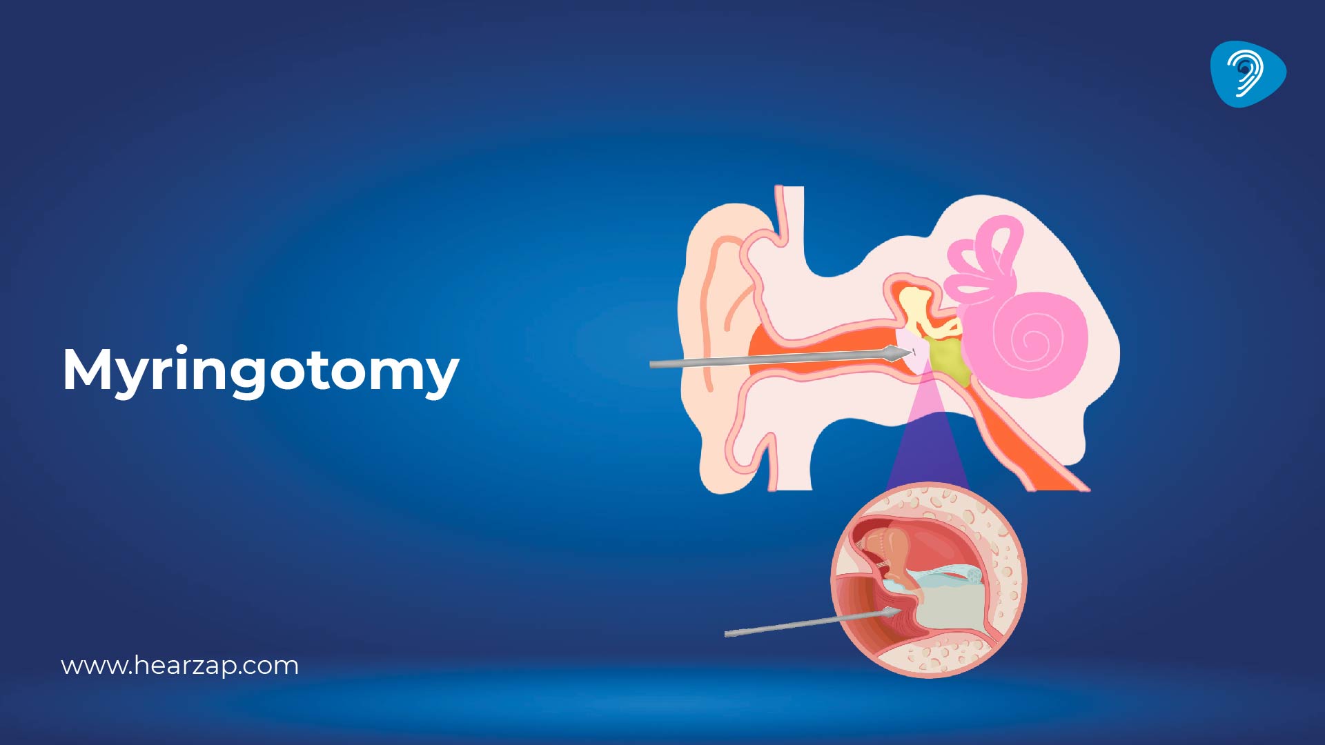 Myringotomy