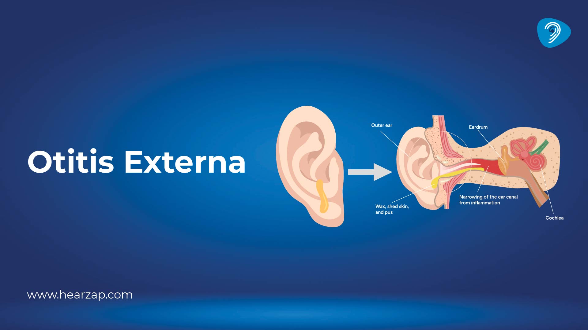 Otitis Externa