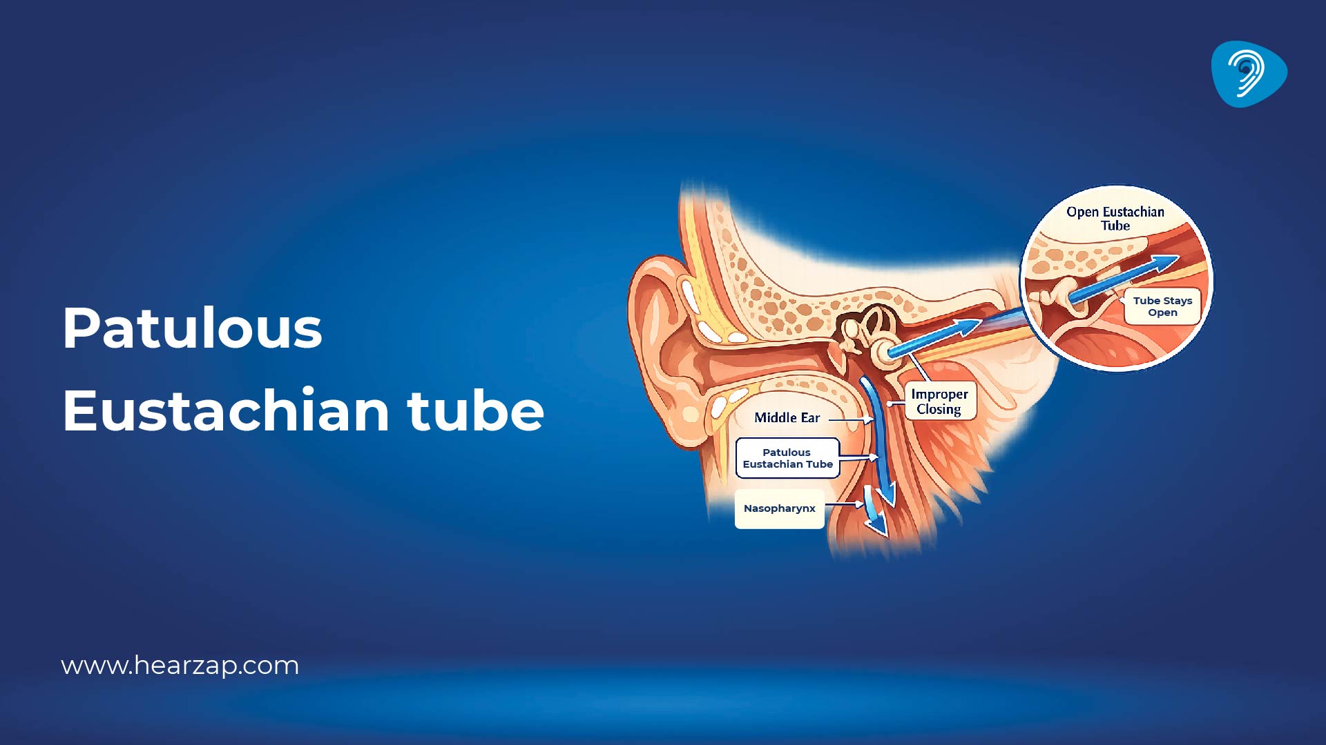 Patulous Eustachian Tube