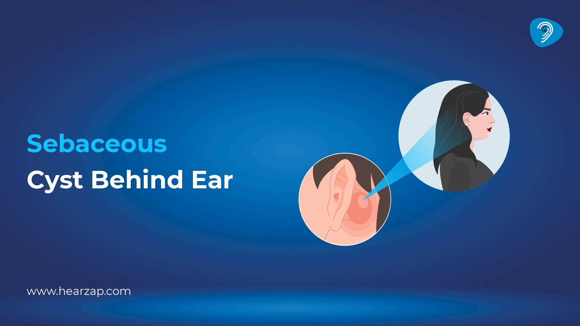 Sebaceous Cyst Behind Ear