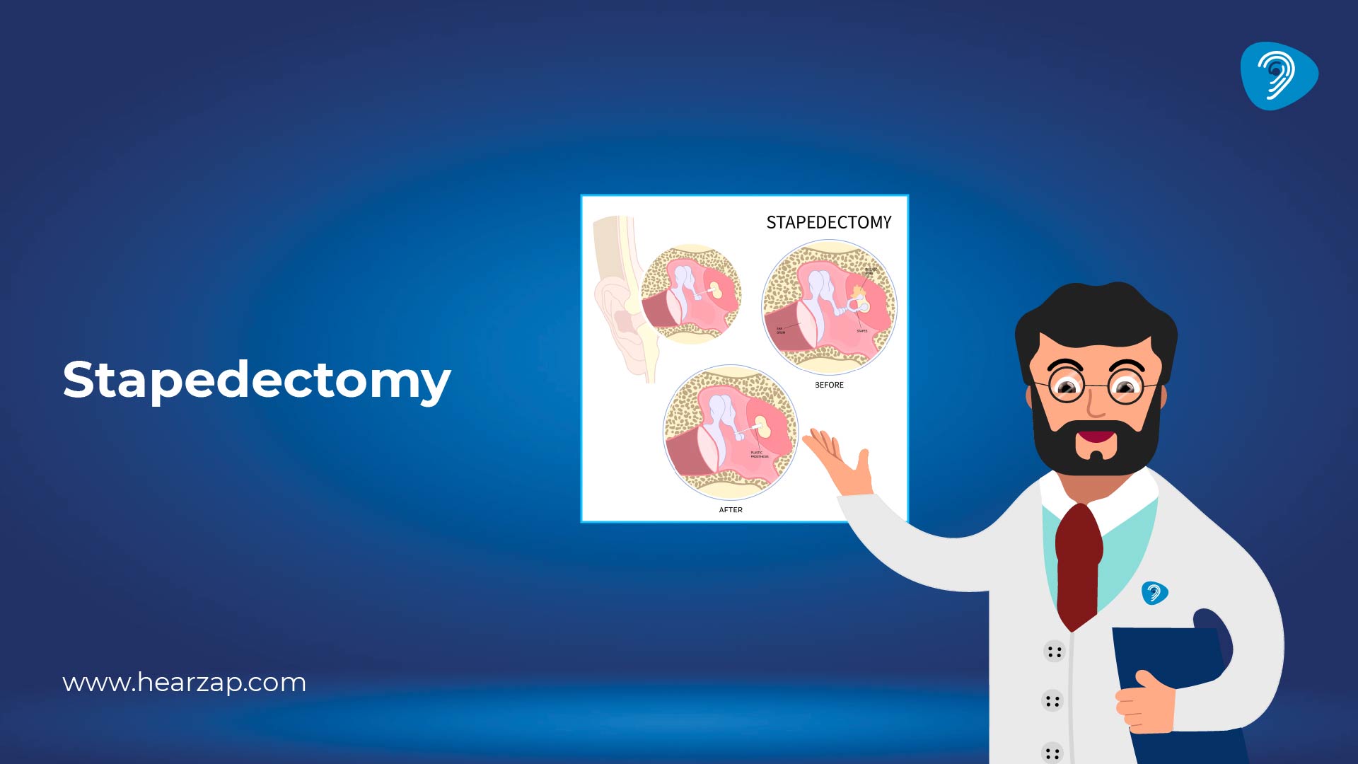  Stapedectomy and Stapedotomy