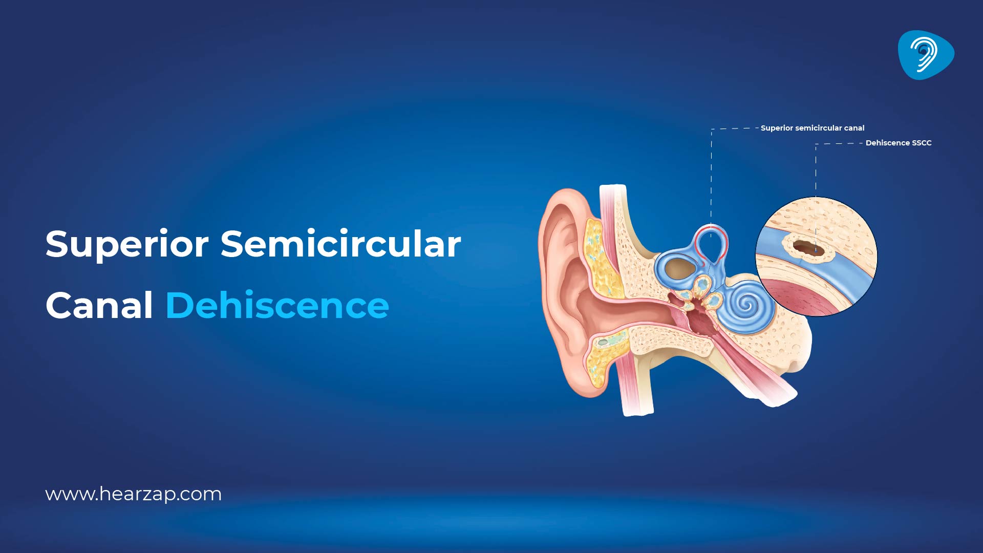 Superior Semicircular Canal Dehiscence 