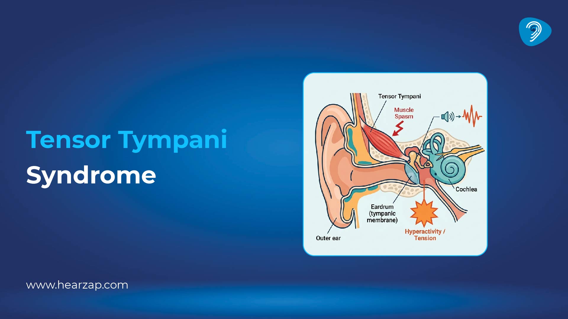  Tensor Tympani Syndrome