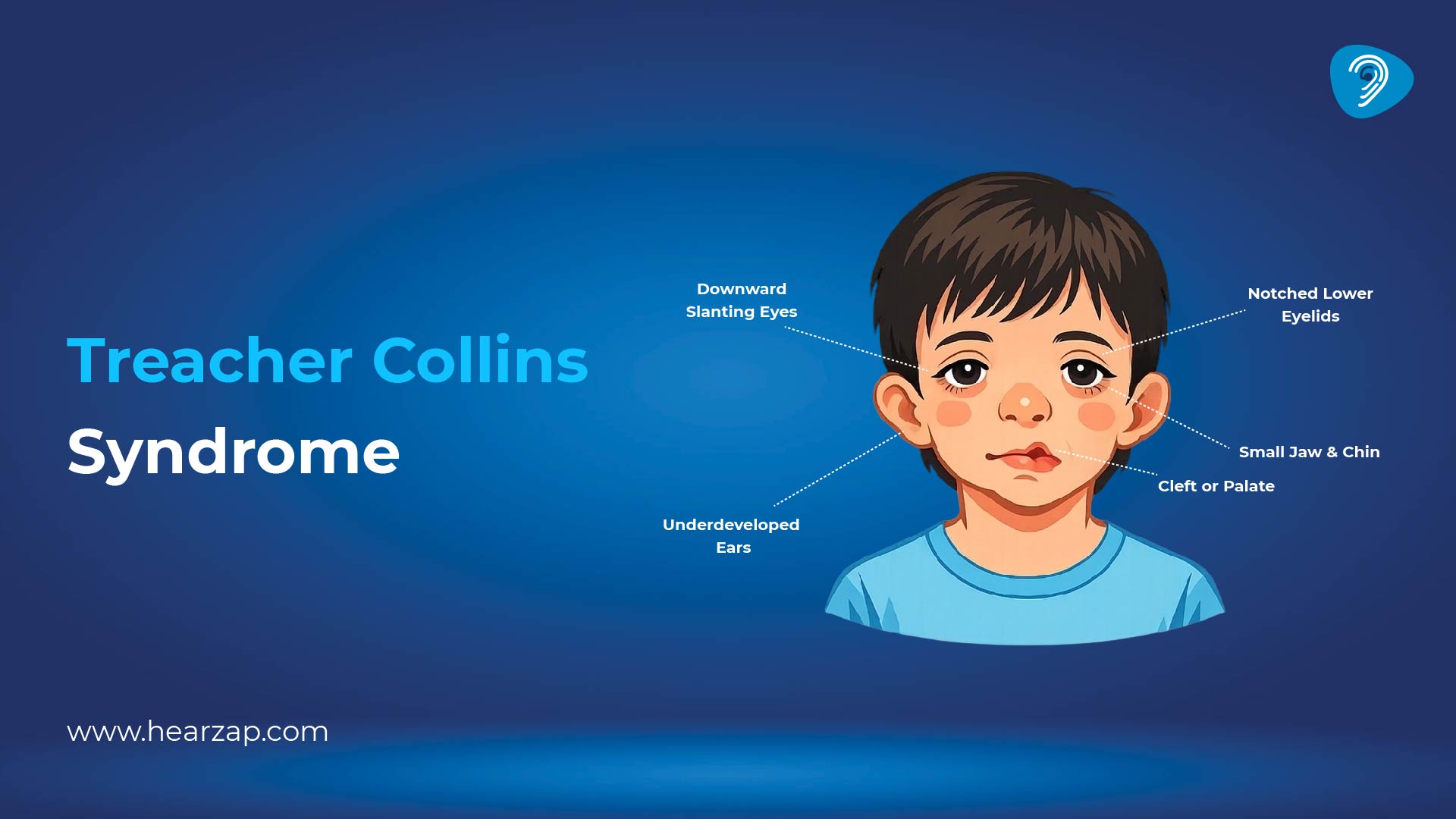 Treacher Collins Syndrome