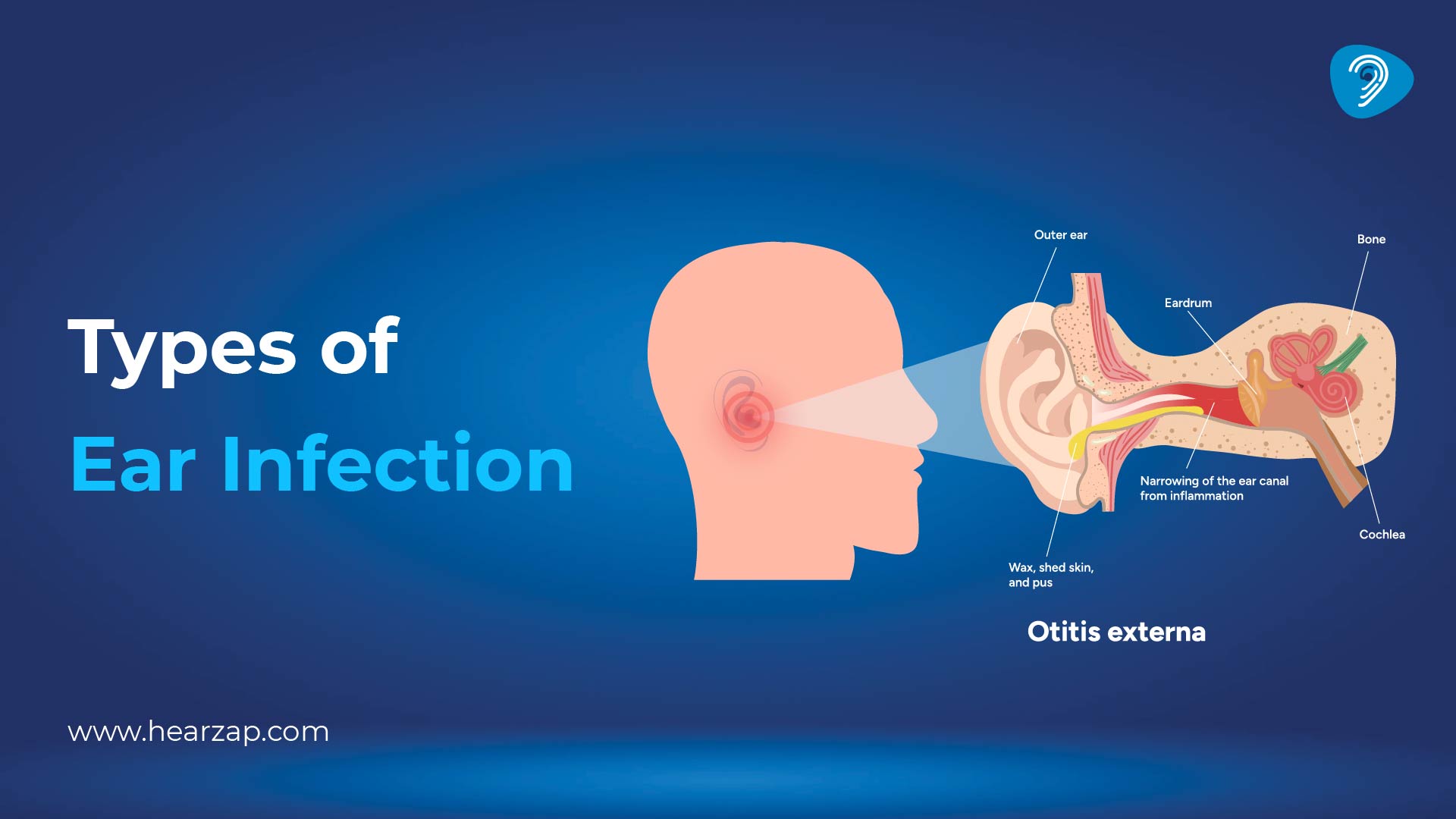 Types of Ear Infections