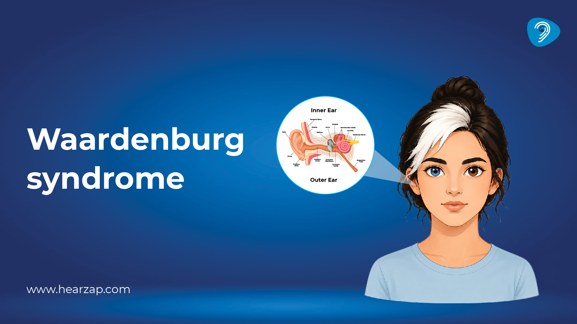 Waardenburg Syndrome
