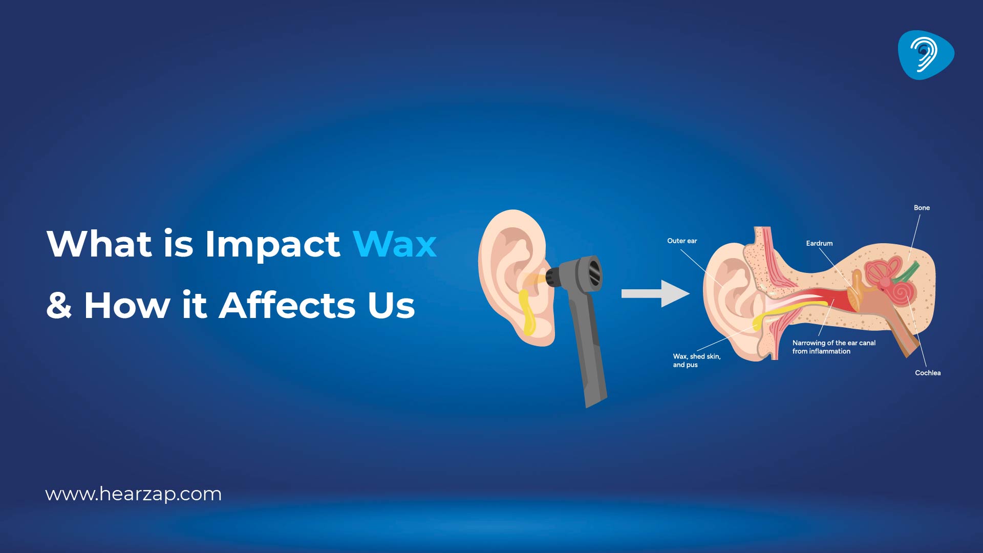 What Is Impacted Earwax?