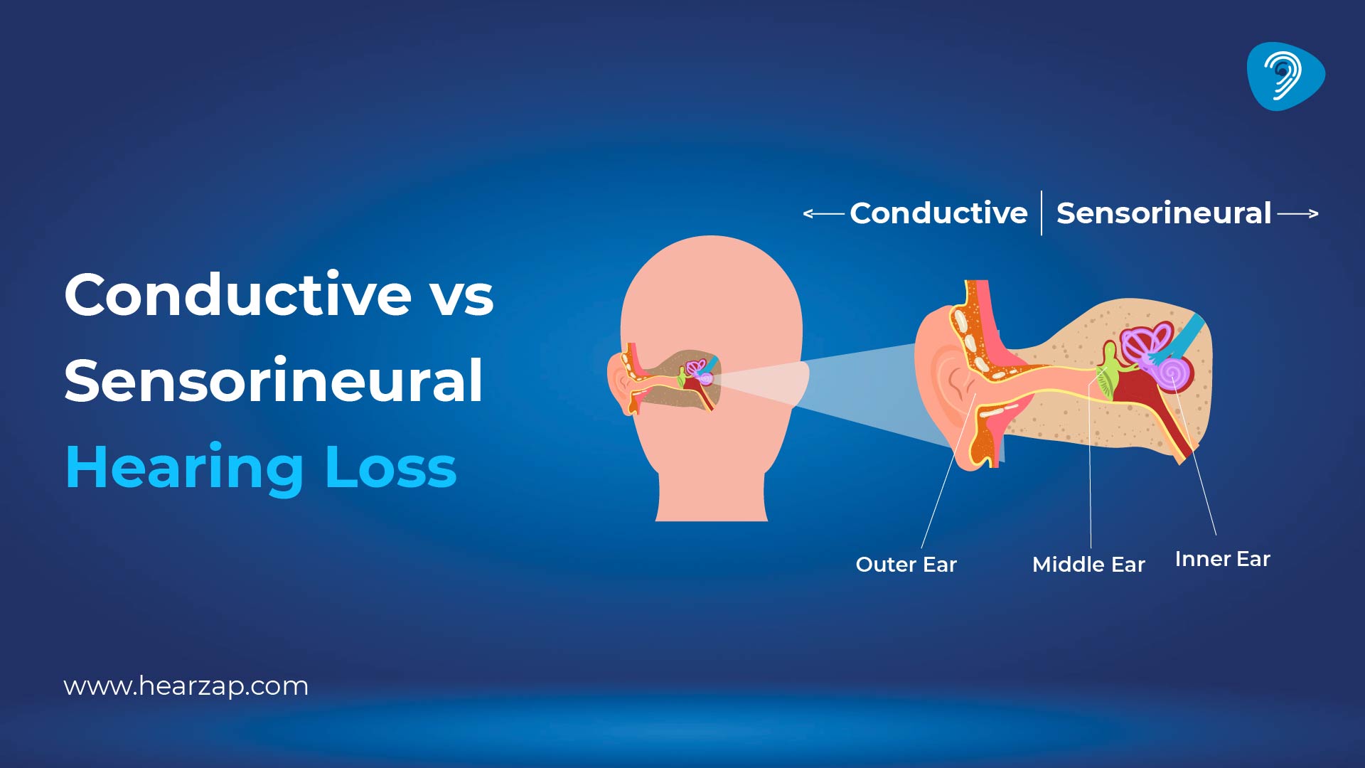 Conductive vs Sensorineural Hearing Loss