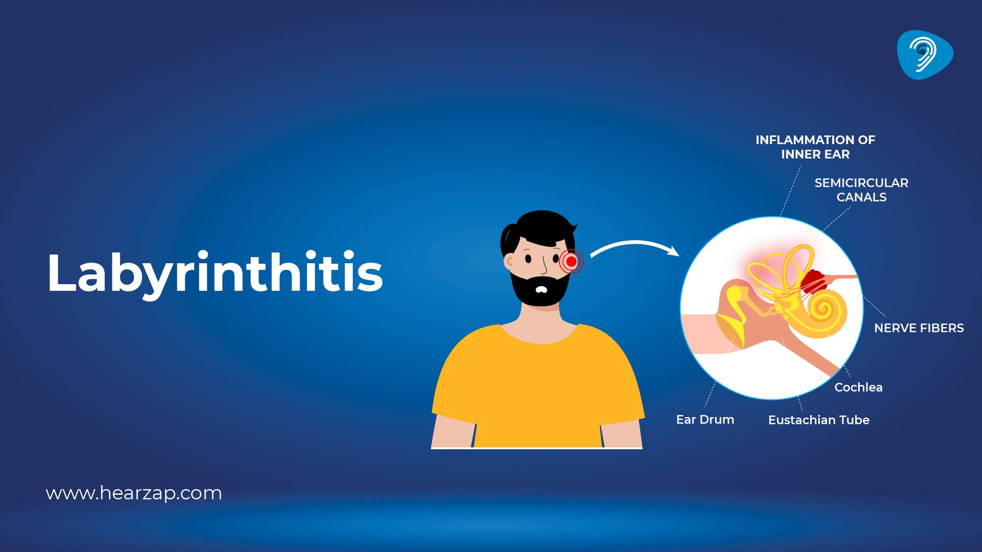 Labyrinthitis: Causes, Symptoms & Treatment