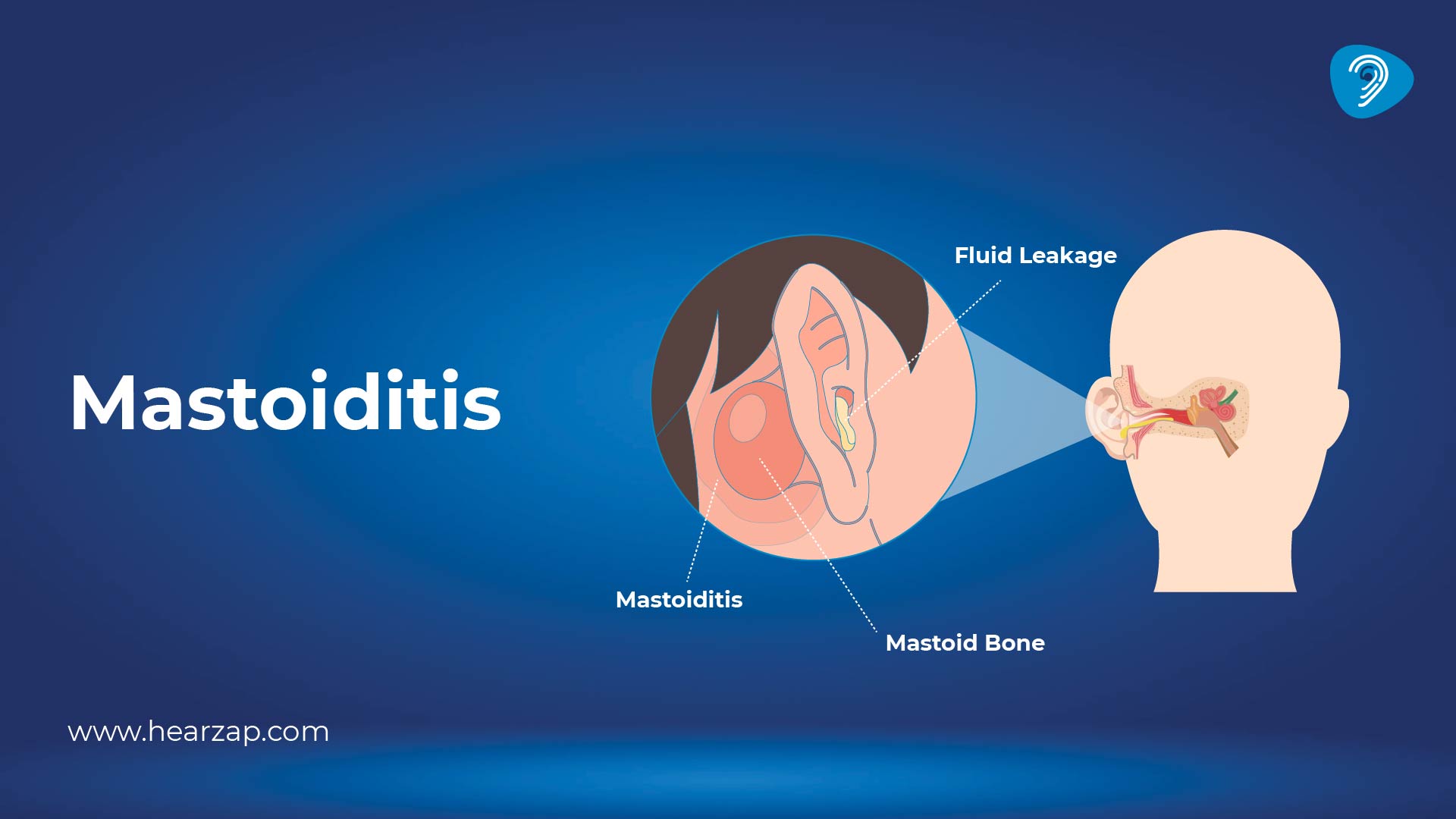 Mastoiditis: Causes, Symptoms, and Treatment Options