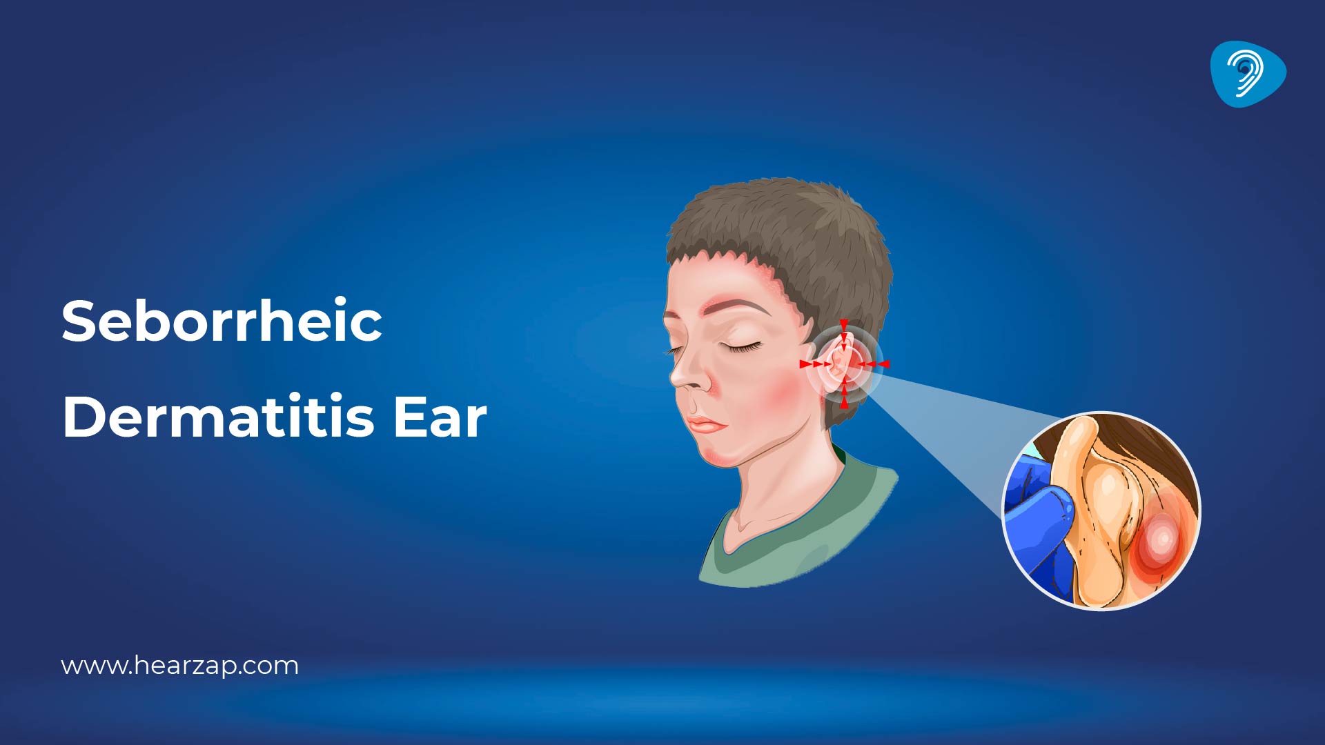 Seborrheic Dermatitis in the Ear
