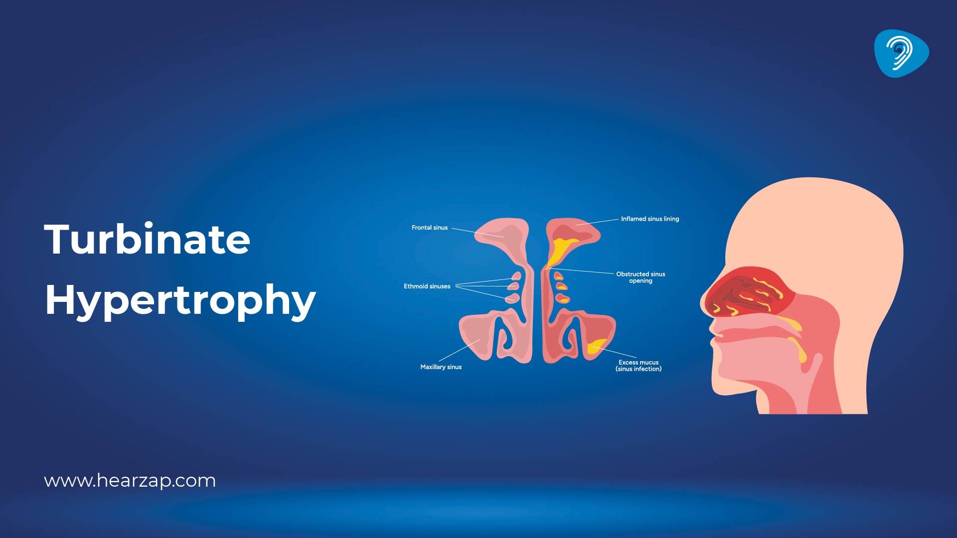  Turbinate Hypertrophy