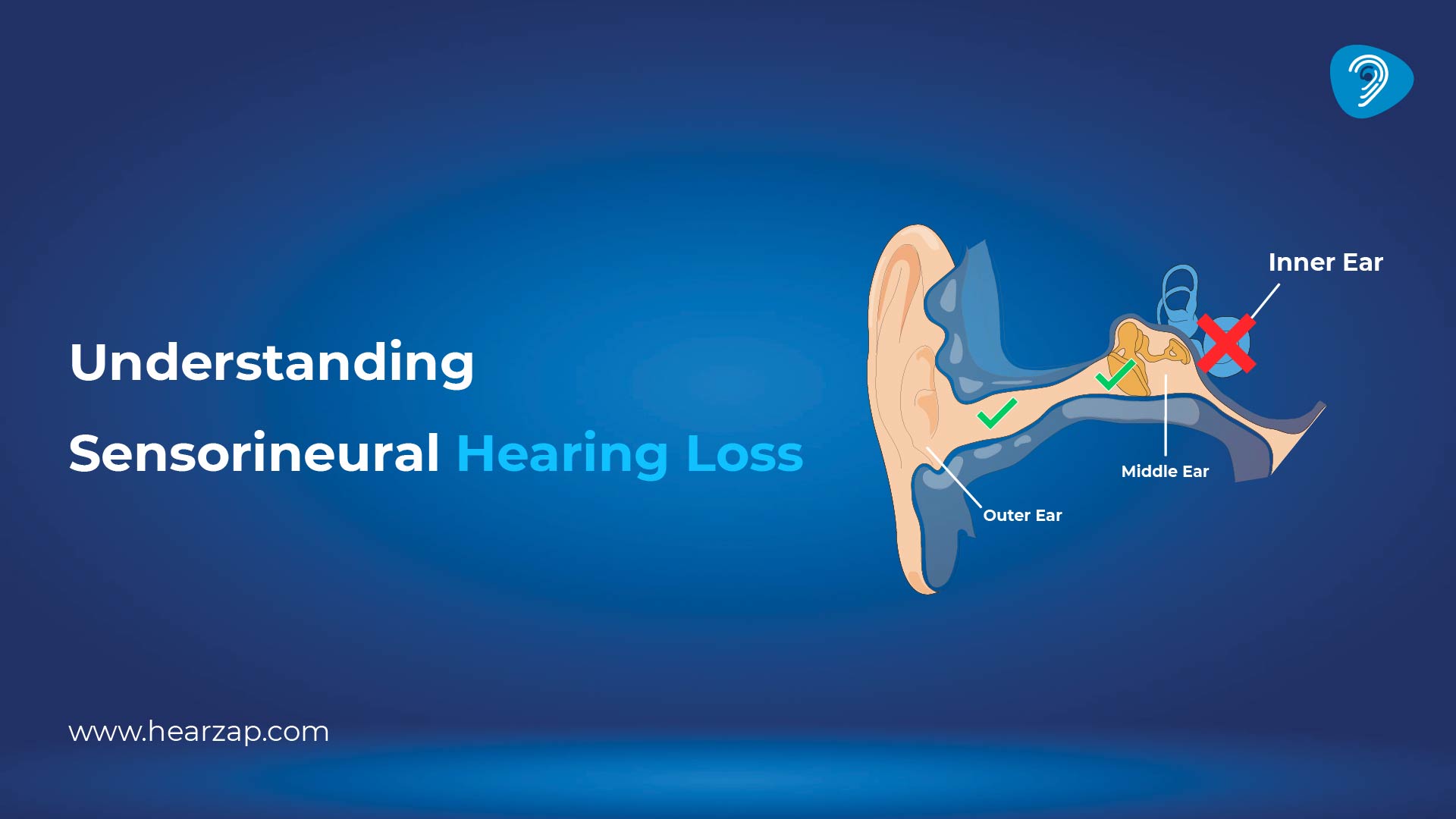  Sensorineural Hearing Loss Symptoms, Causes & Treatment